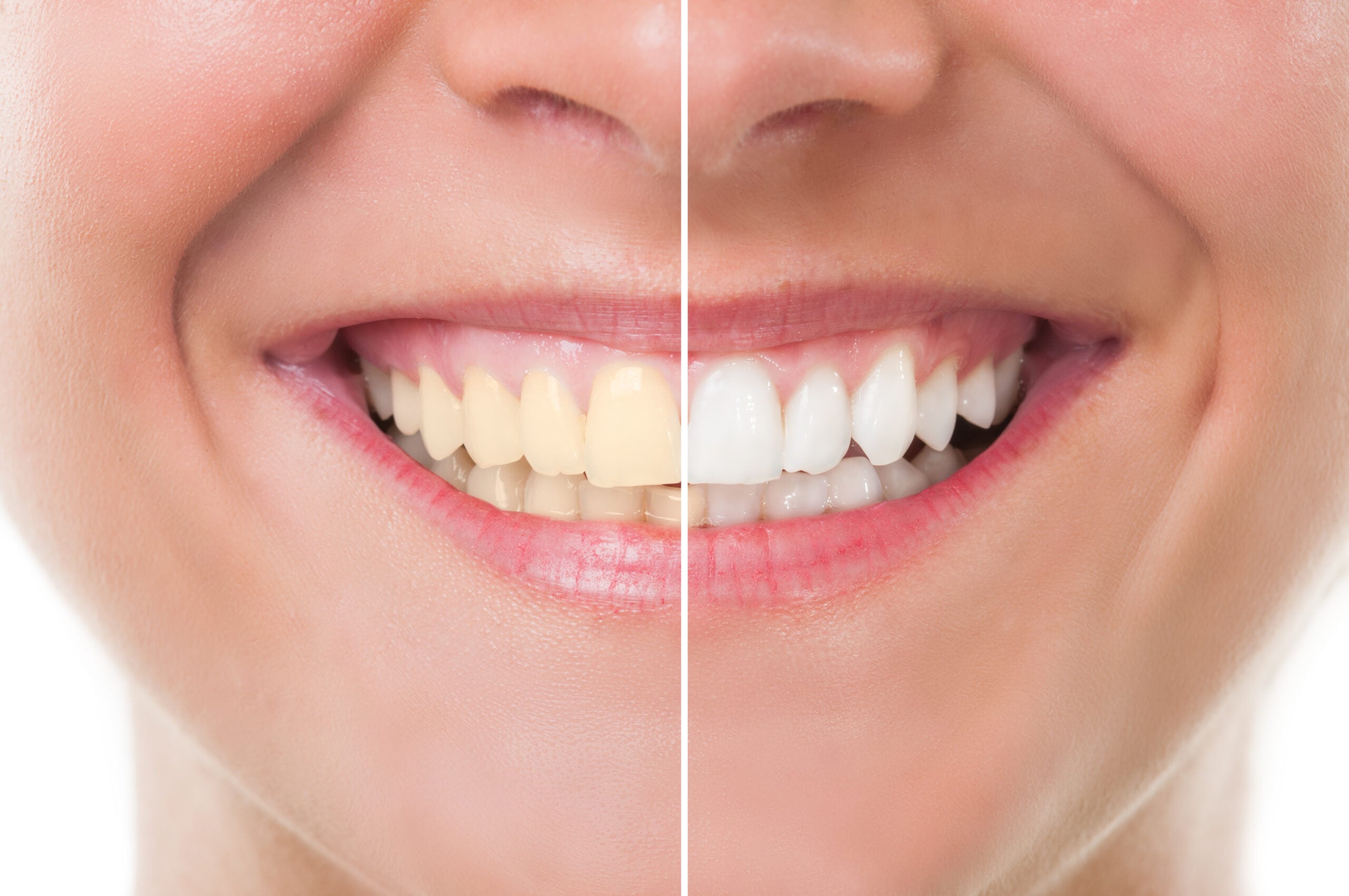 Teeth whitening color comparison